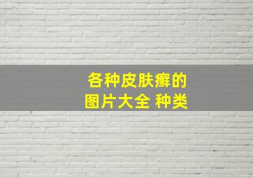 各种皮肤癣的图片大全 种类